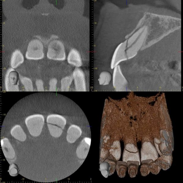 Fracture dentaire avec mobilité d'un fragment