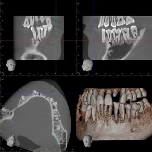 CBCT dentaire