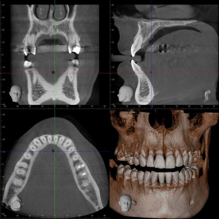Radiographies pour l'extraction des dents de sagesse à Genève