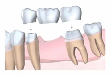 Pont sur dents naturelles