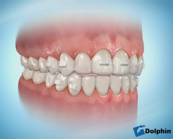Tout savoir sur l'Invisalign à Genève