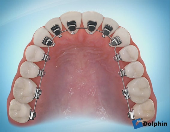 orthodontie lingual
