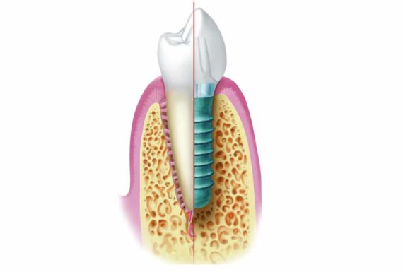 Illustration d'un implant dentaire