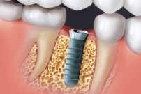 Dessin d'un implant dentaire