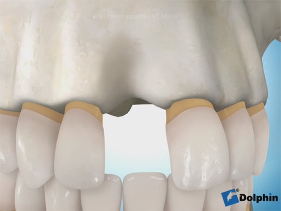 Augmentation osseuse 2