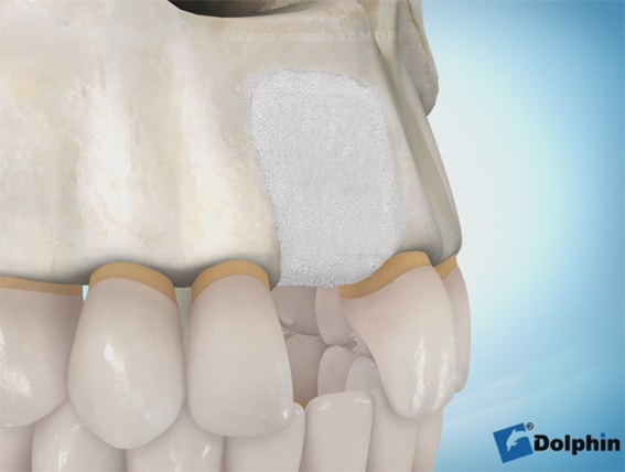 Augmentation osseuse 3