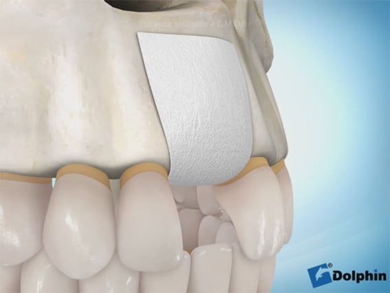 Augmentation osseuse 4