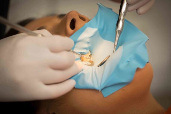 Traitement des caries à Genève dans le Centre Médico-Dentaire Balexert