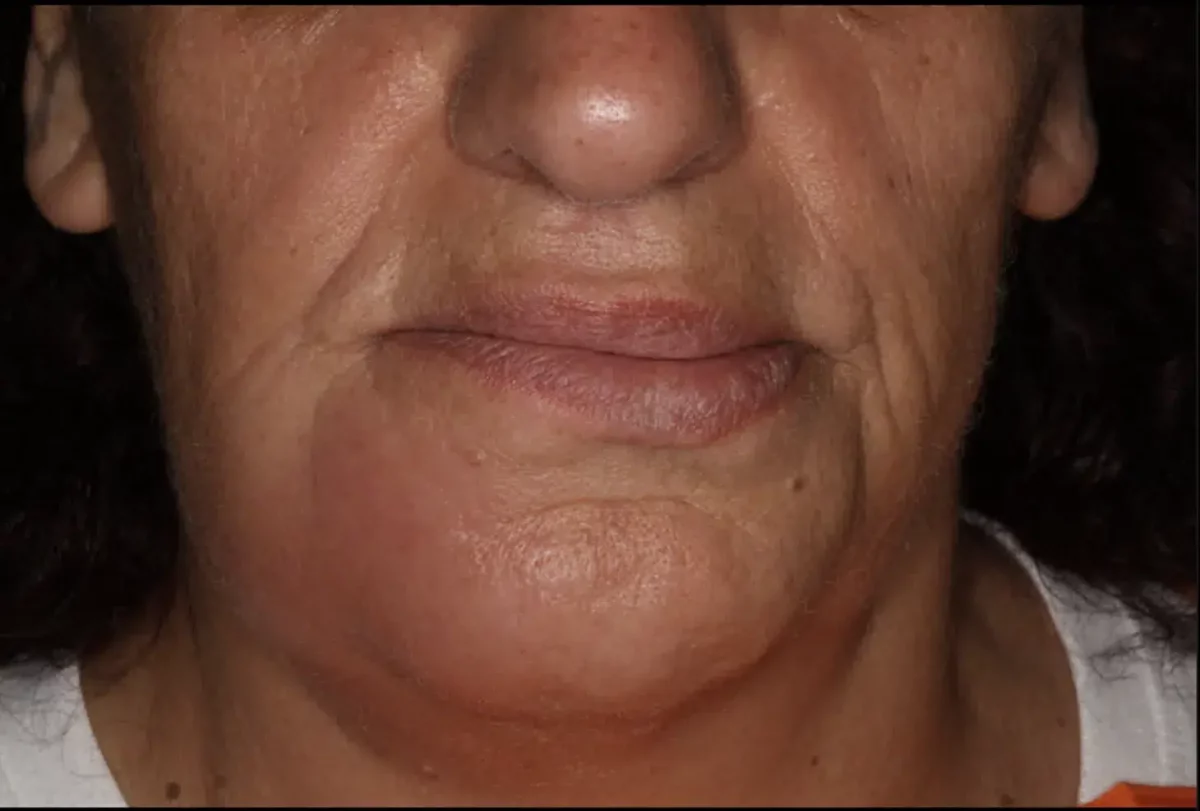 Gonflement du bas du visage chez une patiente